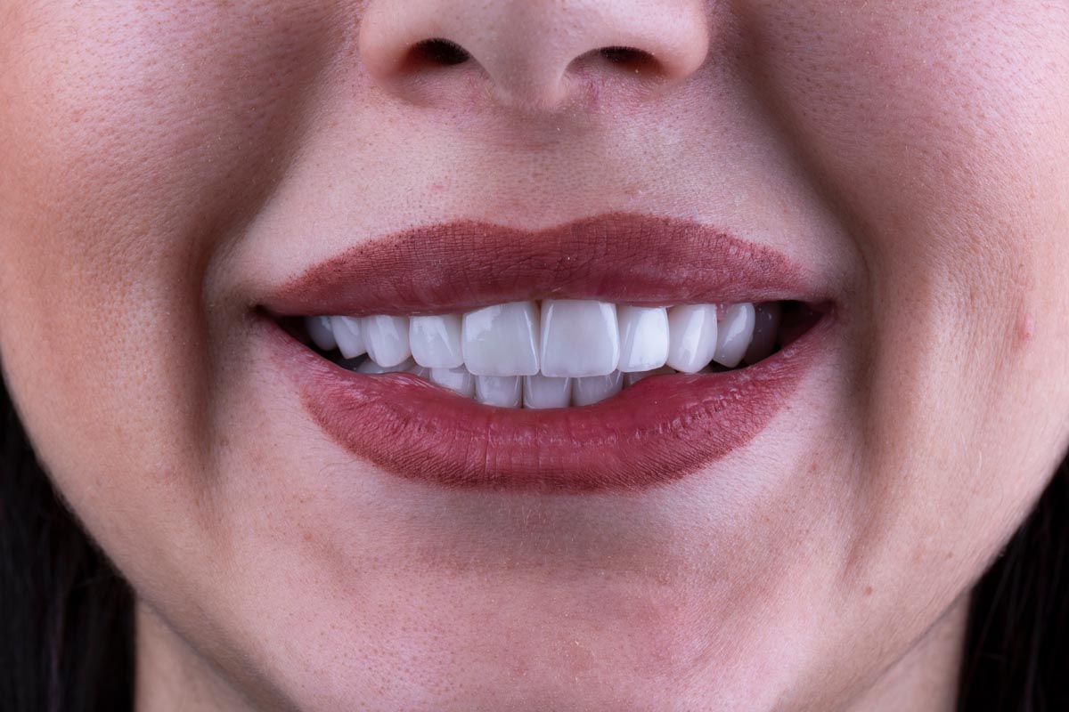Tot ce trebuie să știi despre coroanele dentare ceramice E-max